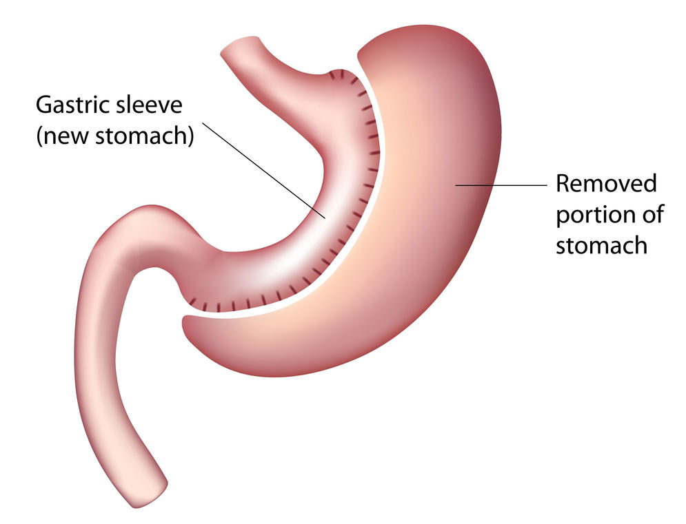 Gastric Sleeve VSG New Haven Derby Milford Connecticut CT